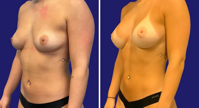 Before and after breast augmentation: woman's breasts, with liposuction and mommy makeover