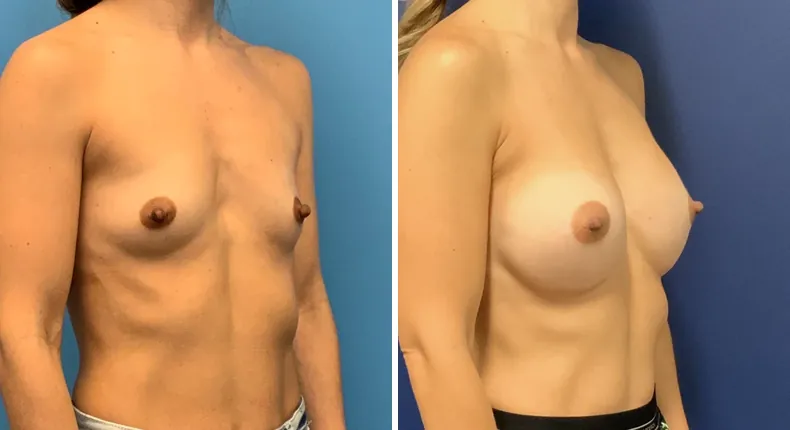 Before and after breast augmentation: woman's breasts at a right angle