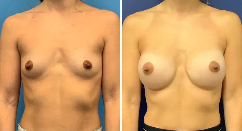 Before and after breast augmentation: woman's breasts from the front