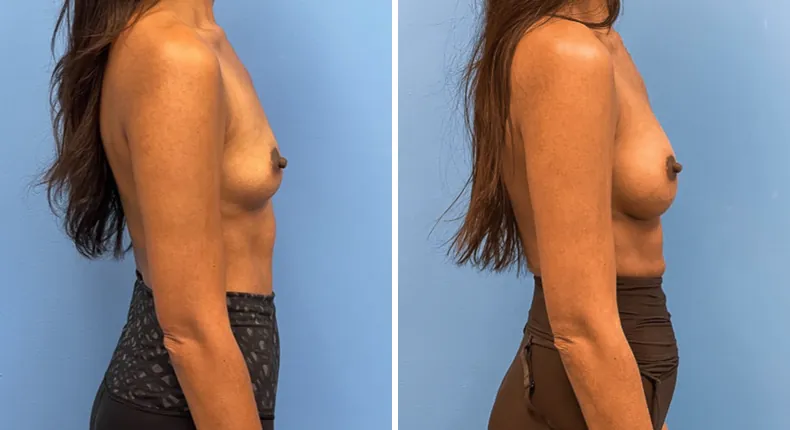 Before and after breast augmentation: woman's breasts from the right side