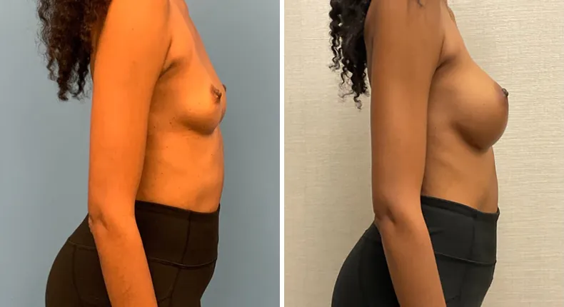 Before and after breast augmentation: woman's breasts from the right side