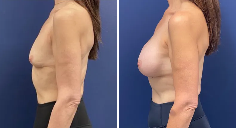 Before and after breast augmentation: woman's breasts from the left side