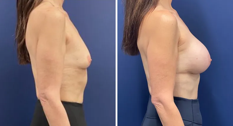 Before and after breast augmentation: woman's breasts from the right side