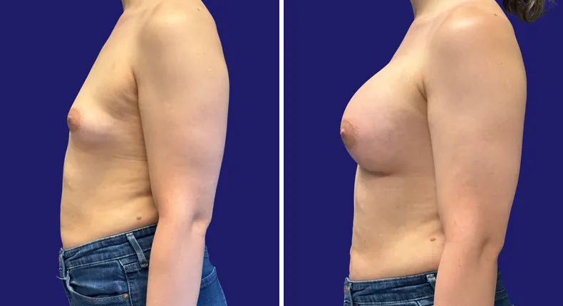Before and after breast augmentation: woman's breasts