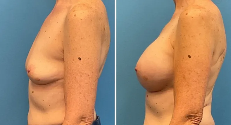 Before and after breast augmentation: woman's breasts from the left side