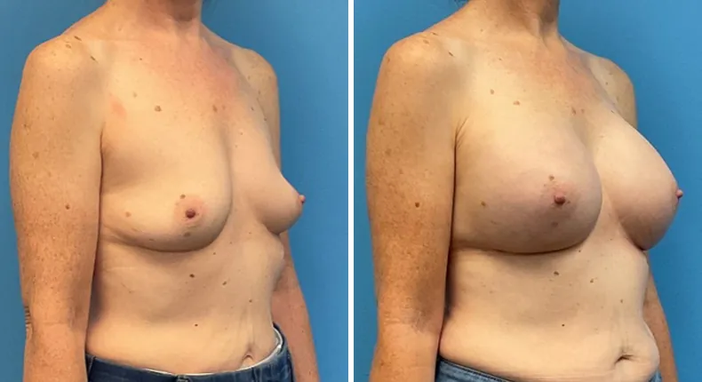Before and after breast augmentation: woman's breasts at a right angle