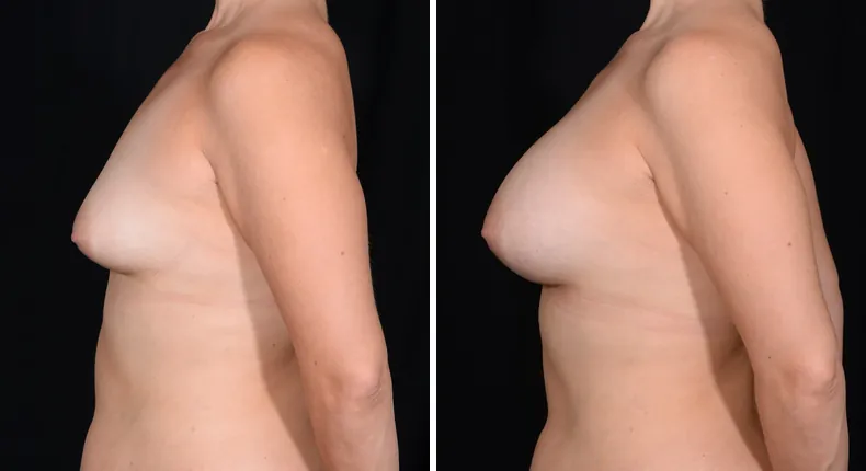Before and after breast augmentation: patient's breasts from the left side