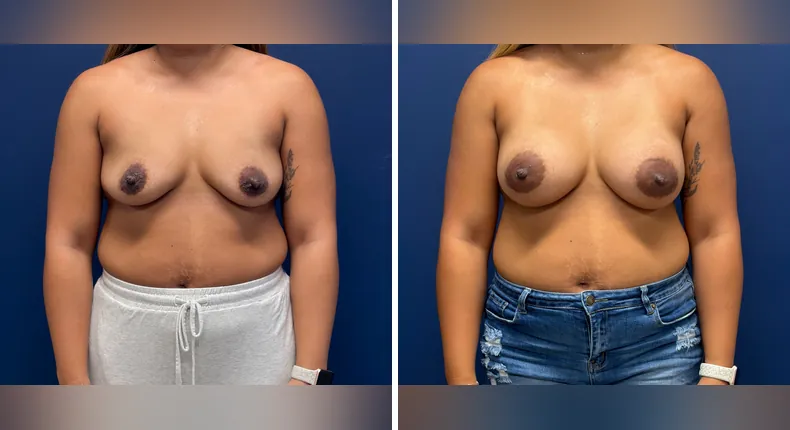 Before and after breast augmentation: woman's breasts
