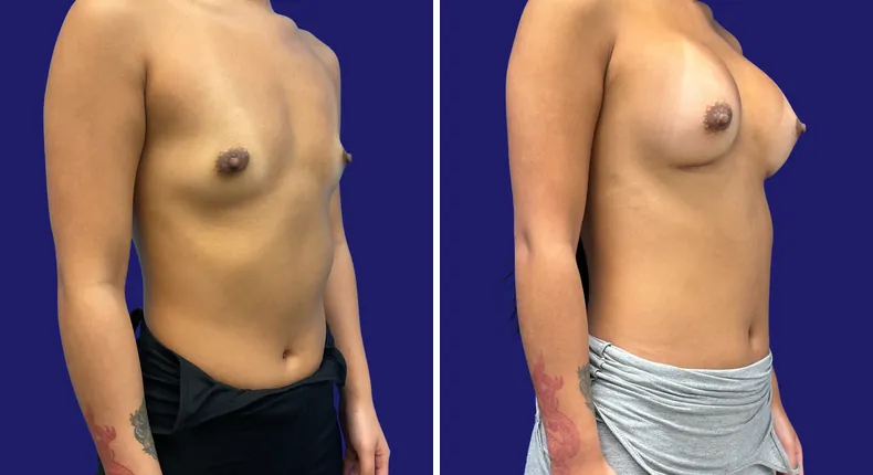 Before and after breast augmentation: woman's breasts