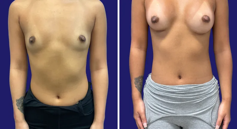 Before and after breast augmentation: woman's breasts