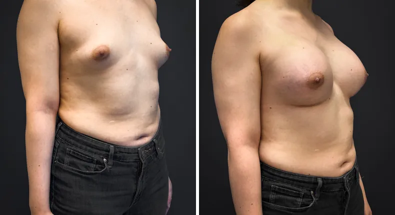 Before and after breast augmentation: patient's breasts from the right side