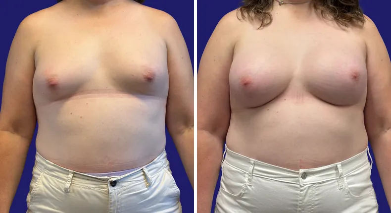 Before and after breast augmentation: patient's breasts from the front