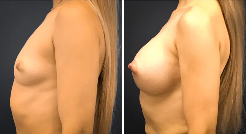 Before and after breast augmentation: woman's breasts in left profile