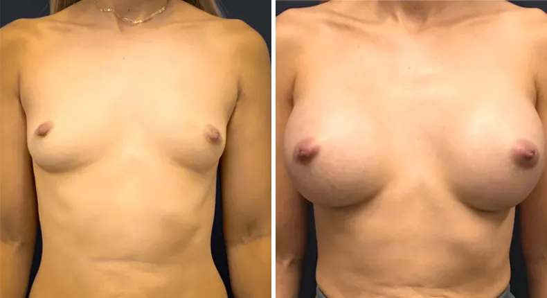Before and after breast augmentation: woman's breasts from the front