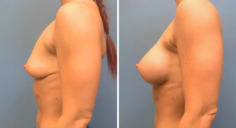 Before and after breast augmentation: woman's breasts from the left side