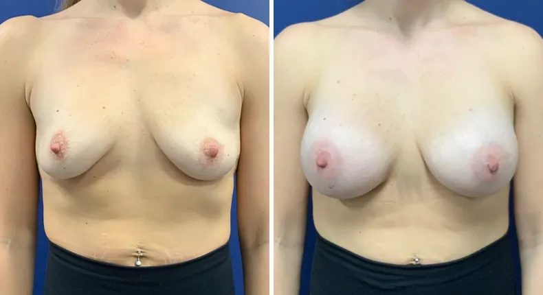Before and after breast augmentation: woman's breasts from the front