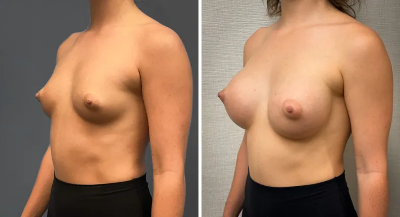Before and after breast augmentation: woman's breasts at a left angle