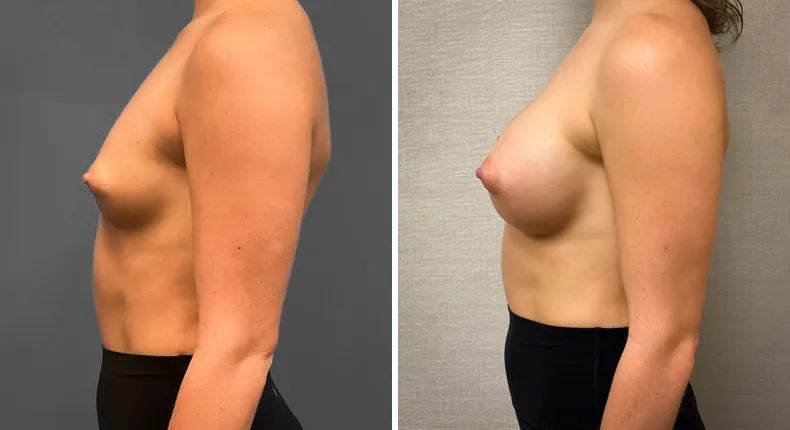 Before and after breast augmentation: woman's breasts from the left side
