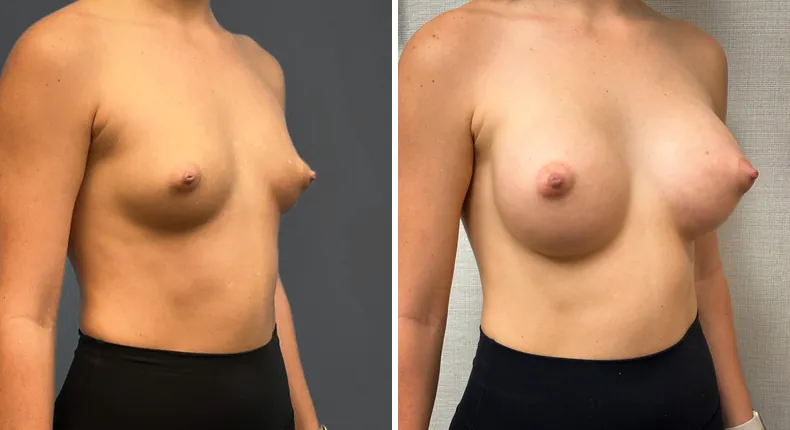 Before and after breast augmentation: woman's breasts at a right angle