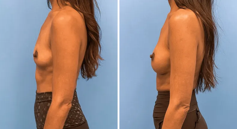 Before and after breast augmentation: woman's breasts from the left side