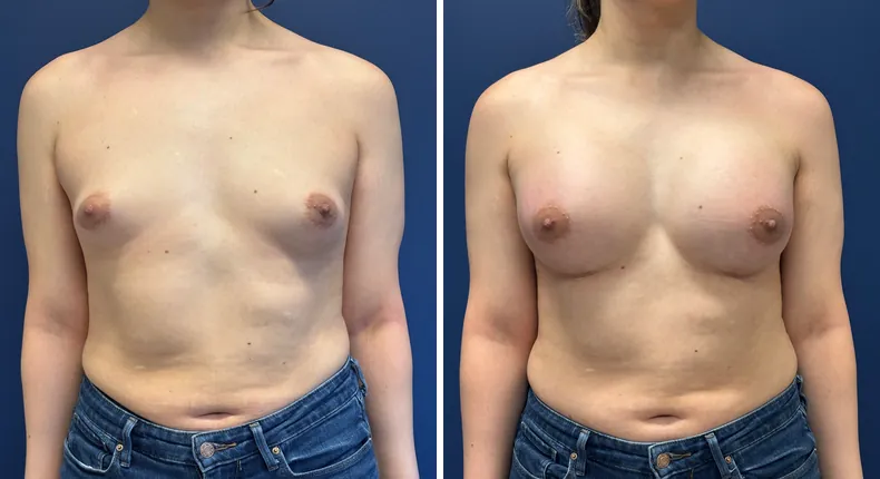Before and after breast augmentation: woman's breasts