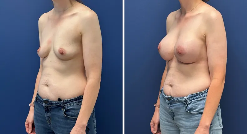 Before and after breast augmentation: patient's breasts at a left angle