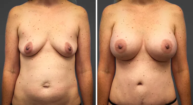 Before and after breast augmentation: patient's breasts