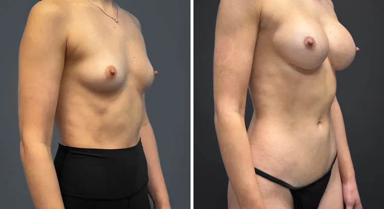Before and after breast augmentation: patient's breasts at a right angle