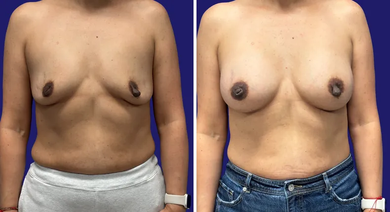 Before and after breast augmentation: woman's breasts from the front