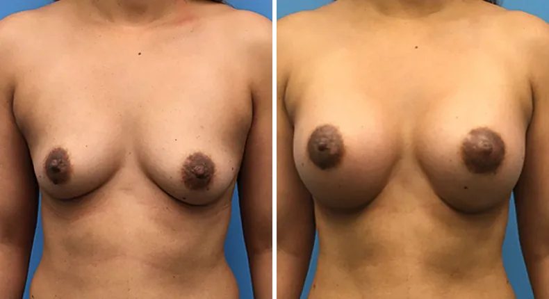 Before and after breast augmentation: woman's breasts from the front