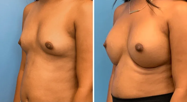 Before and after breast augmentation: patient's breasts at a left angle