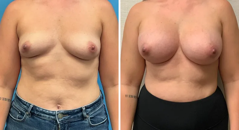 Before and after breast augmentation: woman's breasts from the front