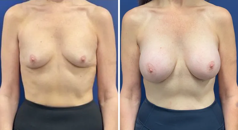 Before and after breast augmentation: woman's breasts from the front