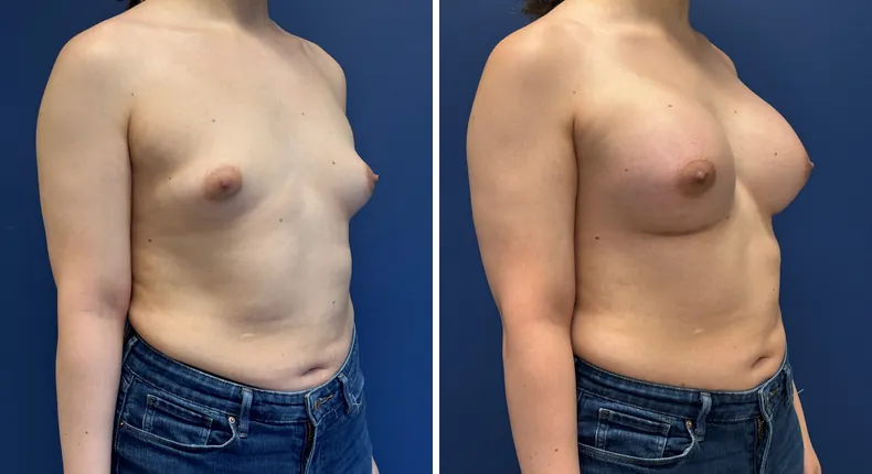 Before and after breast augmentation: woman's breasts at a right angle
