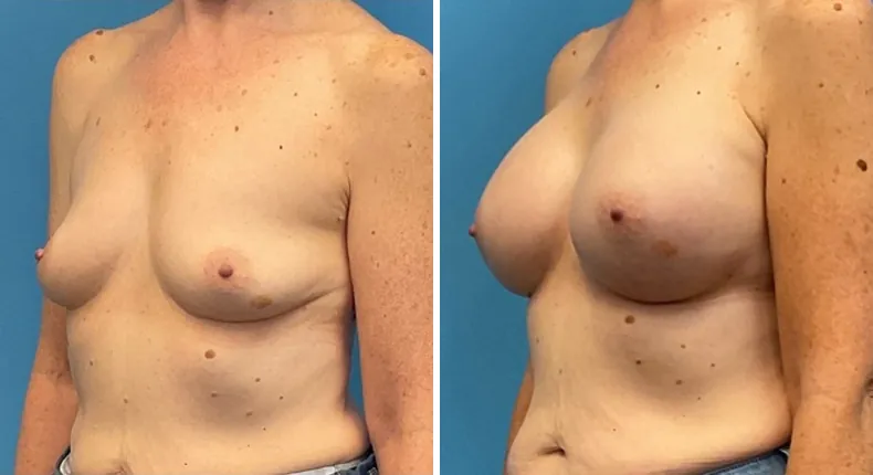 Before and after breast augmentation: woman's breasts at a left angle