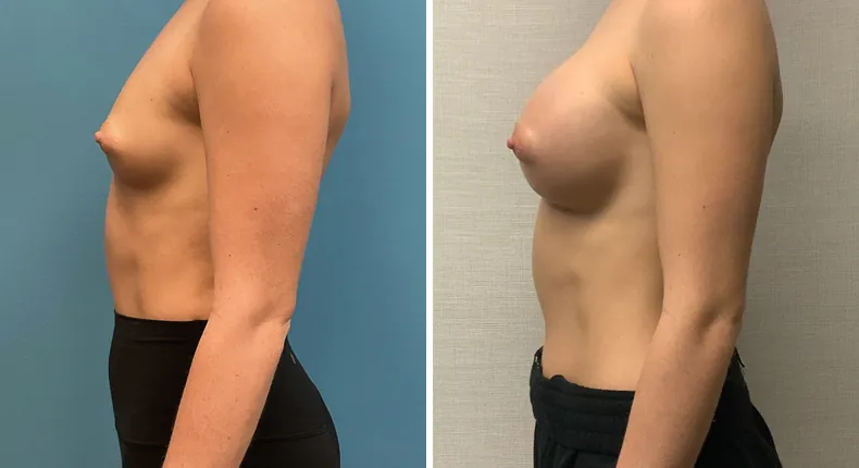 Before and after breast augmentation: patient's breasts in left profile