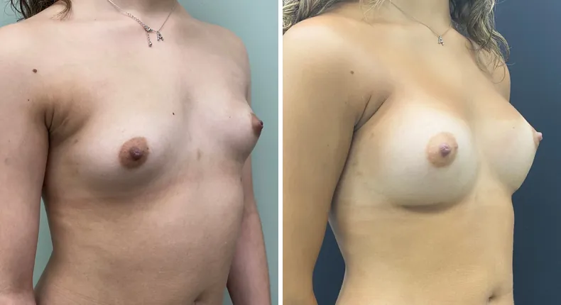Before and after breast augmentation: woman's breasts at a right angle