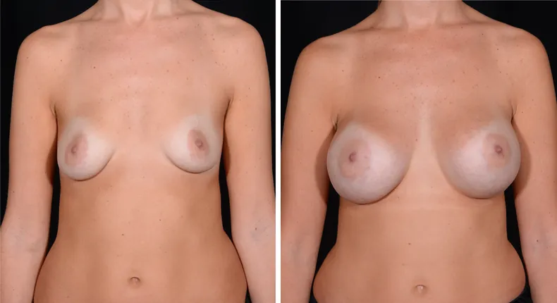 Before and after breast augmentation: patient's breasts from the front