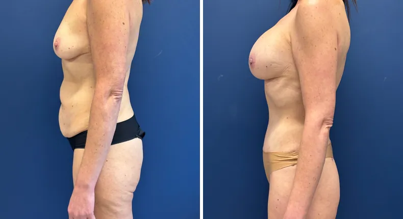 Before and after breast augmentation: patient's breasts from the left side, with tummy tuck