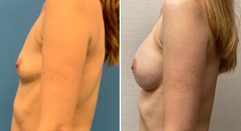 Before and after breast augmentation: woman's breasts in left profile