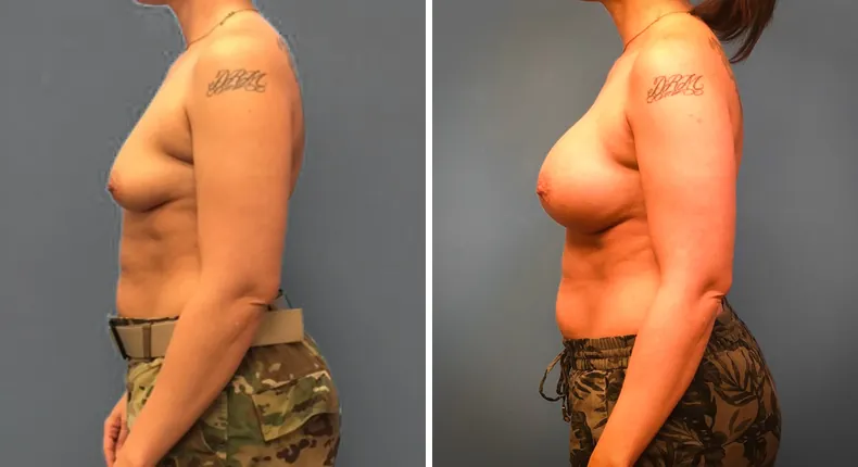 Before and after breast augmentation: patient's breasts