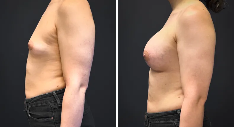 Before and after breast augmentation: patient's breasts from the left side