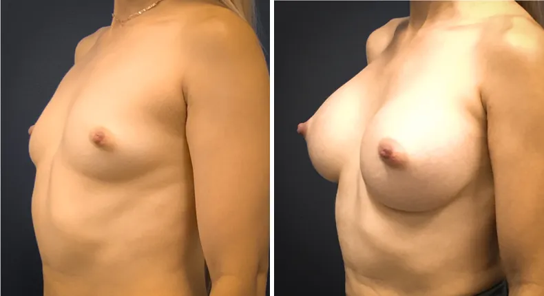 Before and after breast augmentation: woman's breasts at a left angle
