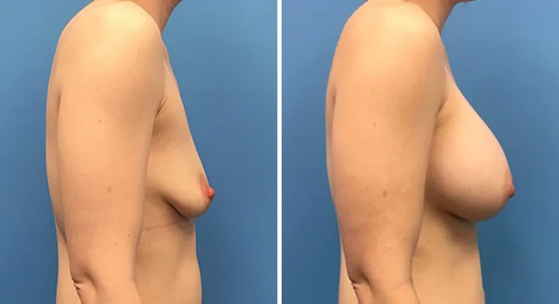 Before and after breast augmentation: patient's breasts from the right side