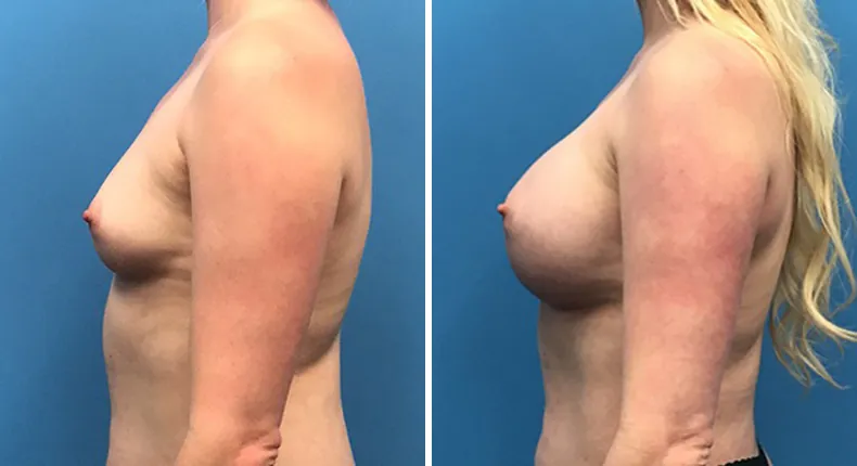 Before and after breast augmentation: woman's breasts from the left side