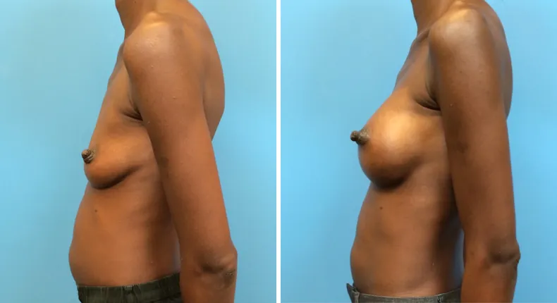 Before and after breast augmentation: woman's breasts from the left side