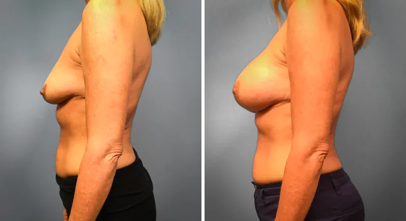 Before and after breast augmentation: woman's breasts
