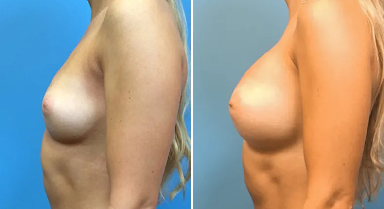Before and after breast augmentation: woman's breasts from the left side