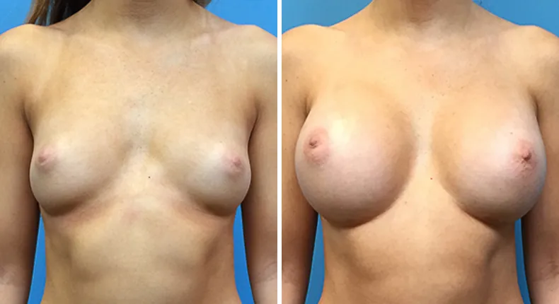 Before and after breast augmentation: woman's breasts from the front