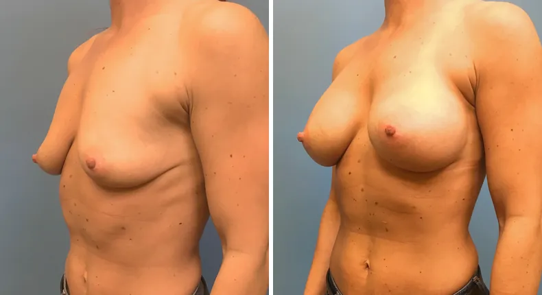 Before and after breast augmentation: woman's breasts at a left angle